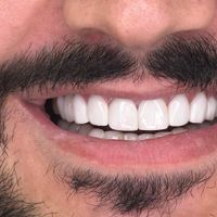 ایمپلنت و کامپوزیت زیبایی دندانپزشکی|خدمات آرایشگری و زیبایی|تهران, افسریه|دیوار