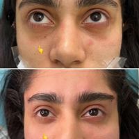 کلینیک تزریق ژل بوتاکس فیلر زیرچشم هایفولیزر انزیم|خدمات آرایشگری و زیبایی|کرج, گوهردشت|دیوار
