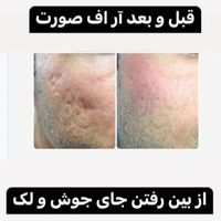 لیزر مو های زائد بانوان و آقایان، تضمینی|خدمات آرایشگری و زیبایی|تهران, تهرانپارس غربی|دیوار