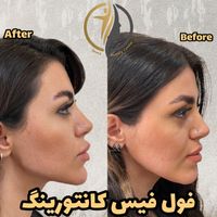 افر استثنایی خدمات زیبایی تزریق ژل و لیزر و فیشال|خدمات آرایشگری و زیبایی|تهران, سعادت‌آباد|دیوار