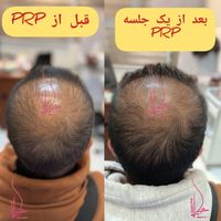 پی ار پی مو،صورت،اگزوزوم،مزوتراپی،هیرفیلر PRP|خدمات آرایشگری و زیبایی|تهران, هفت حوض|دیوار