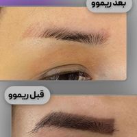 پاک کردن تتوی صورت شما تخصص ماست|خدمات آرایشگری و زیبایی|تهران, منیریه|دیوار