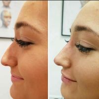 کلینیک تزریق ژل بوتاکس فیلر زیرچشم هایفولیزر انزیم|خدمات آرایشگری و زیبایی|کرج, گوهردشت|دیوار