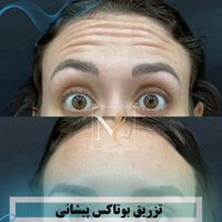 جشنواره یلدایی ژل،نخ،بوتاکس،فیلرلب ازسیصدهزارتومان|خدمات آرایشگری و زیبایی|تهران, نیاوران|دیوار