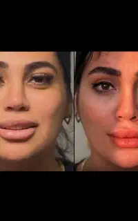 بوکال فت/کات گونه دائمی توسط جراح فوق تخصص پلاستیک
