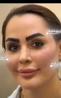 ساکشن غپغپ تزریق چربی فیلر و بوتاکس آموزش خدمات