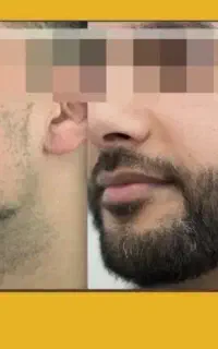 درمان ریزش مو سر و صورت