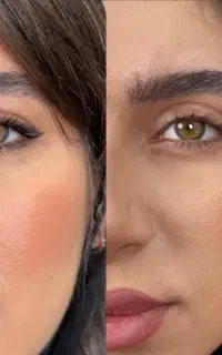 بلفاروپلاستی با روش چشم گربه ای