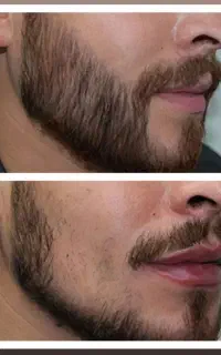 پکیج باسازی رویش مو و ریش