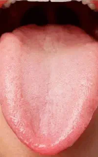 سونوگرافی زبان