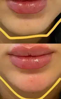 تخفیف ژل وبوتاکس وکاشت مو