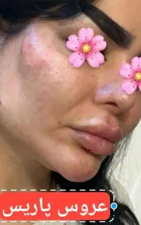 خدمات ژل وبوتاکس و پروتئن