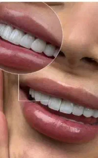 لمینیت / دندان پزشکی / عصب کشی / روکش / بلیچینگ