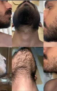 کم‌پشتی ریش راه‌حل داریم