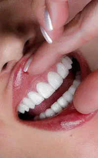 دندانپزشکی،ایمپلنت،اوردنچر،روکش در تبریز