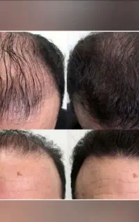 یک قدم تا موهای پرپشت