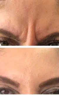 تزریق بوتاکس