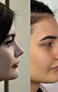 جشنواره پائیز جراحی بینی