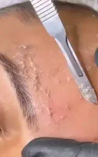 اصلاح درماپلینگ