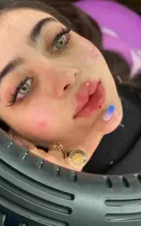 فیلرژل،بوتاکس،کربوکسی،مزوفیشیال،ریموتتوخال نخ لیفت