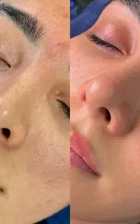 پاکسازی صورت فقط فقط ۲۸۰ تومان
