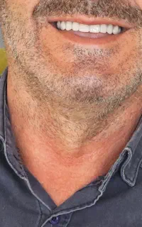 ساخت دست دندان