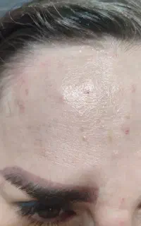 بوتاکس و ژل