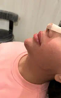 تزریق ژل وبوتاکس prp توسط پزشک در مطب باقیمت مناسب
