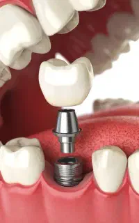 دندانپزشکی.ایمپلنت فقط با۳میلیون