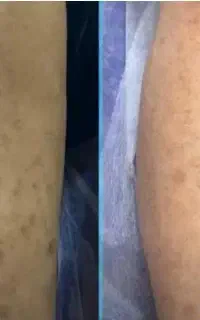 نواحی تیره بدن وصورت را در ۴جلسه روشن ماندگار کنید