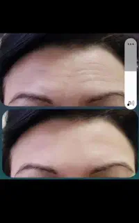 جشنواره رفع کک،مک صورت دوجلسه وبوتاکس درسهندوتبریز