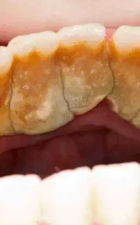 جرم گیری دندان رایگان
