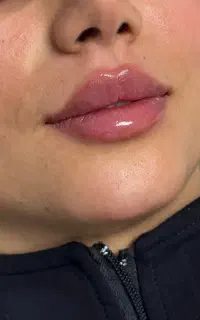 بوتاکس چشم گربه ای،لب عروسکی،چونه فانتزی