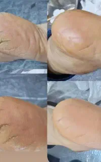 آموزش تخصصی پدیکوردرمانی،میخچه،مانیکور و اسپای دست