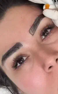 میکرو کاشت با 10میلیون تومان تخفیف