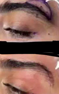 کاشت ابرو +دایرکت ابرو+ژل وبوتاکس