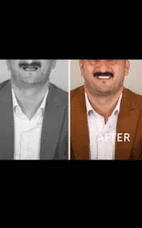 ایمپلنت دیجیتال یک روزه