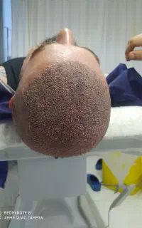 کاشت مو ابرو ریش