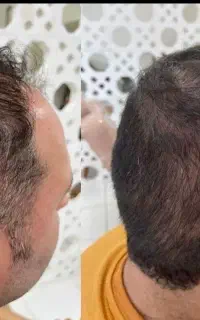 عسله لامصب