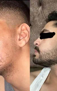 یک قدم تا ریشی ضخیم تر