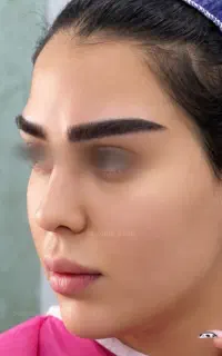 میکرو کاشت ابرو با تخفیف ویژه تیرماه .فقط۱۵نفر
