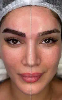 کاشت تار به تار ابرو