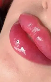 تزریق ژل
