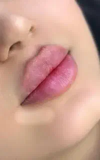 لیفت پوست و جوانسازی تزریق لب ،چونه،گونه،خط خنده