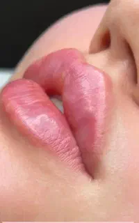 تزریق ژل و بوتاکس و فیلر لب
