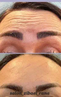 تخفیف خدمات ژل،بوتاکس،پیرسینگ،کاشت مژه،کاشت ناخن