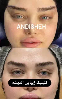 جراحی زیبایی بلفاروپلاستی،مینی لیفت صورت