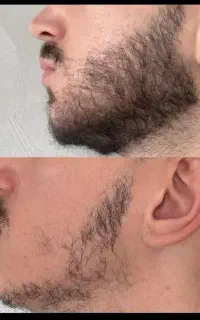قطع ریزش و رویش ریش و پرپشتی ریش