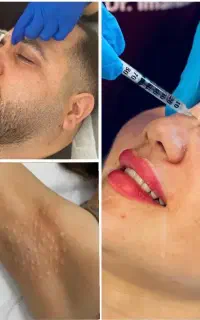 بوتاکس کل صورت ( پیشانی ، زیربغل ، کف دست و پا )