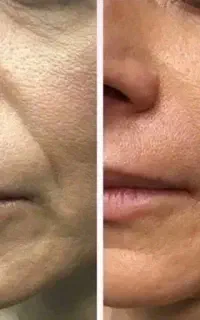 کرم بیوممتیک ضدچروک اصل ایتالیایی(جایگزین بوتاکس)